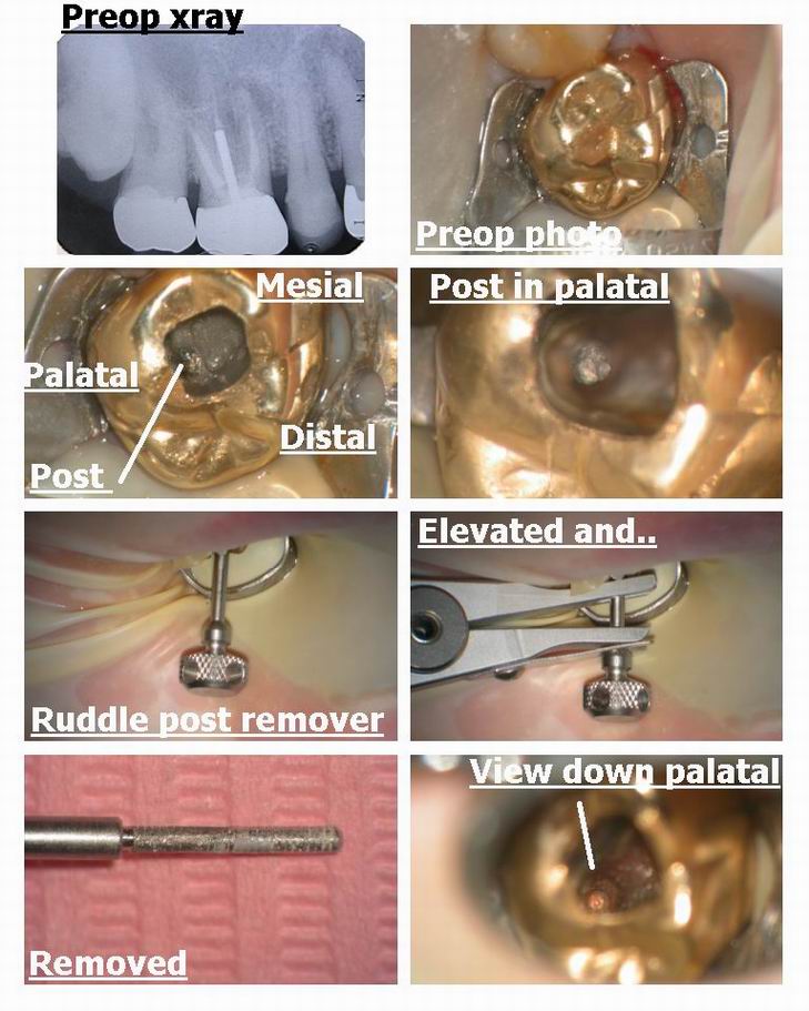 Resize of Incision and drain retreat pg 1.jpg